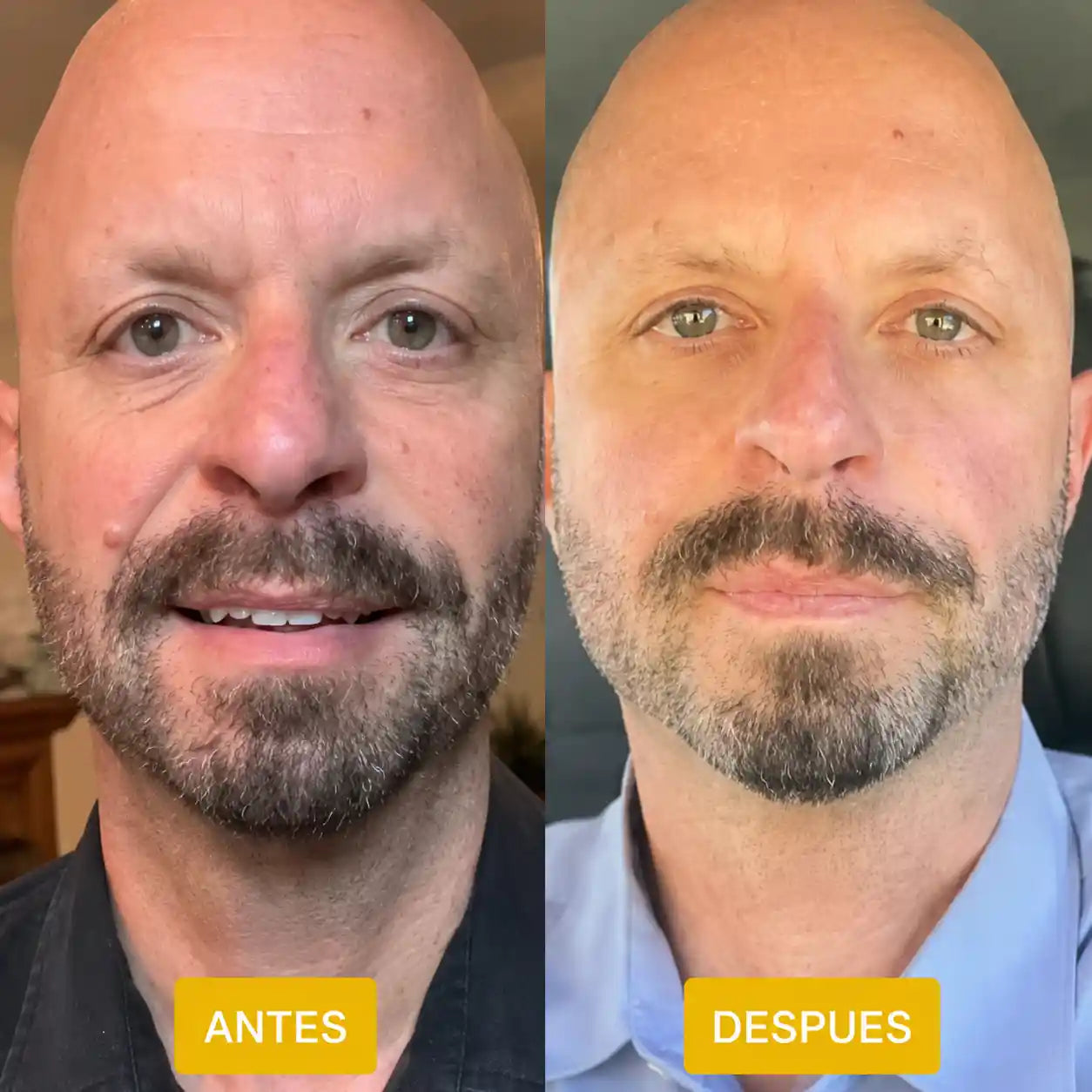 Bolsas y ojeras