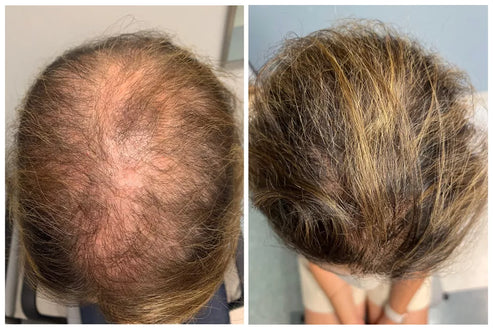 FolixDerm – Reactiva tu Crecimiento Capilar