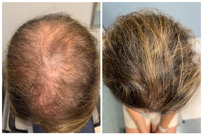 FolixDerm – Reactiva tu Crecimiento Capilar